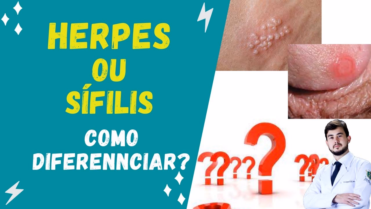 What is the difference between a syphilis and a herpes sore?