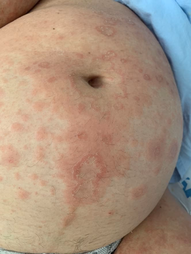 ¿Cuáles son los síntomas de la combinación de herpes y embarazo?