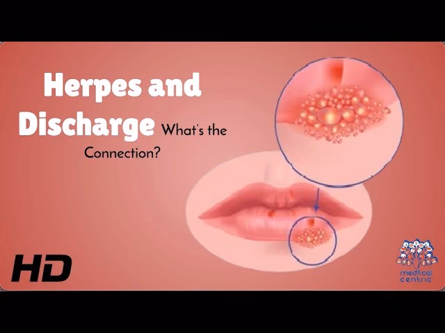 How do you know if you have herpes?