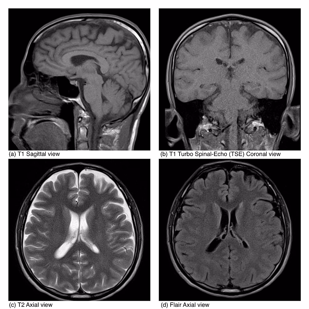 How is HHV-6 encephalitis treated?