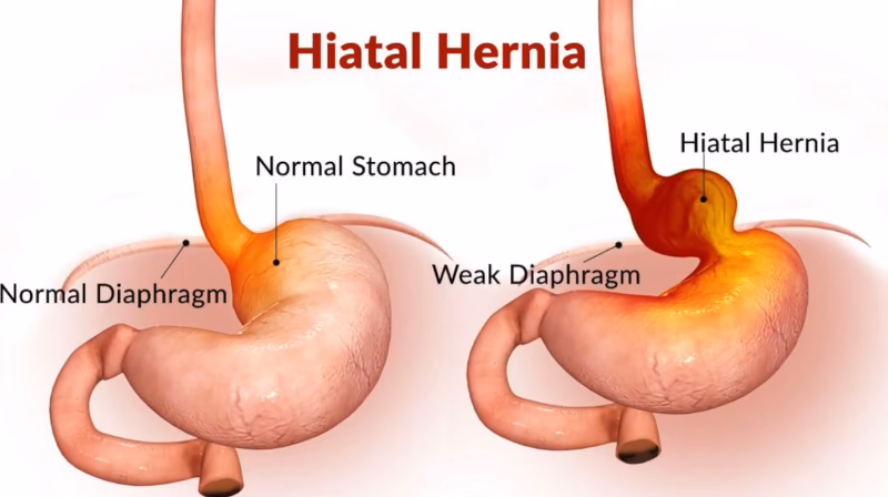 Are hiatal hernias asymptomatic?