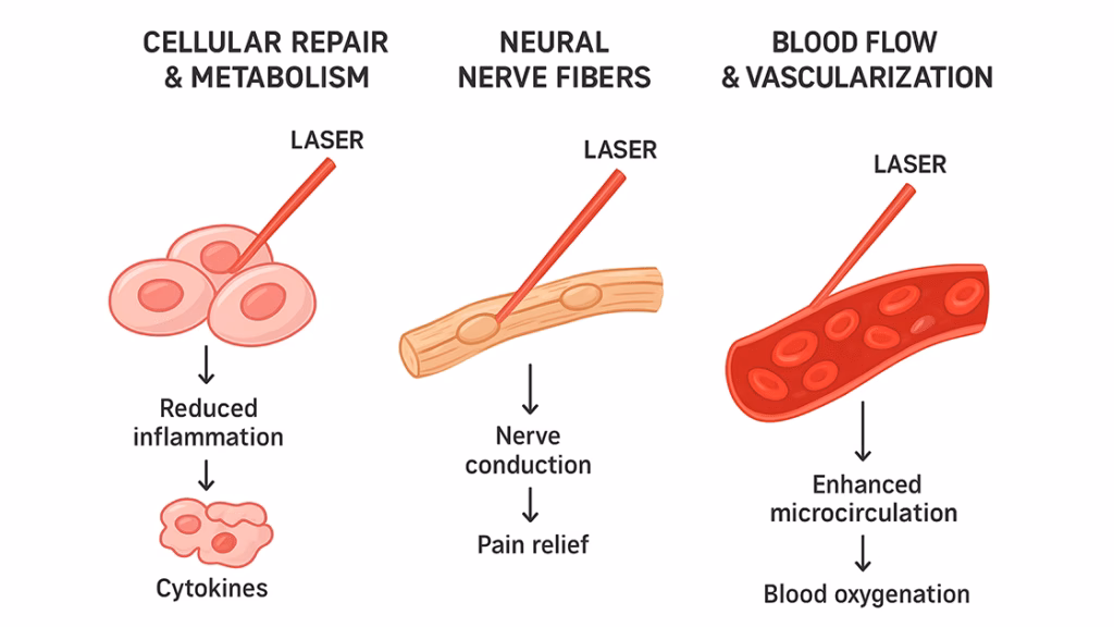 What is high-intensity laser therapy (hilt)?