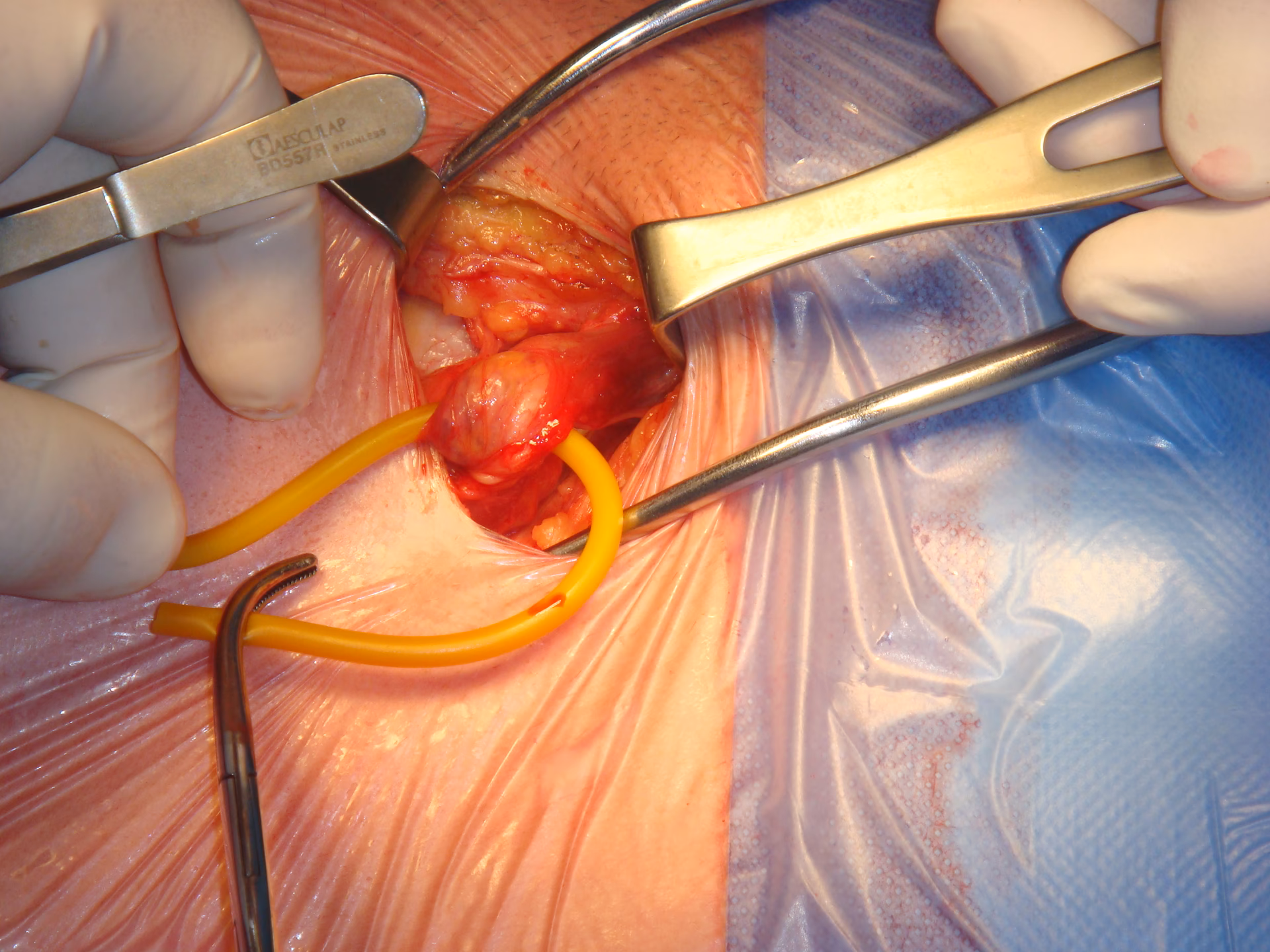 What is a hernia surgery?