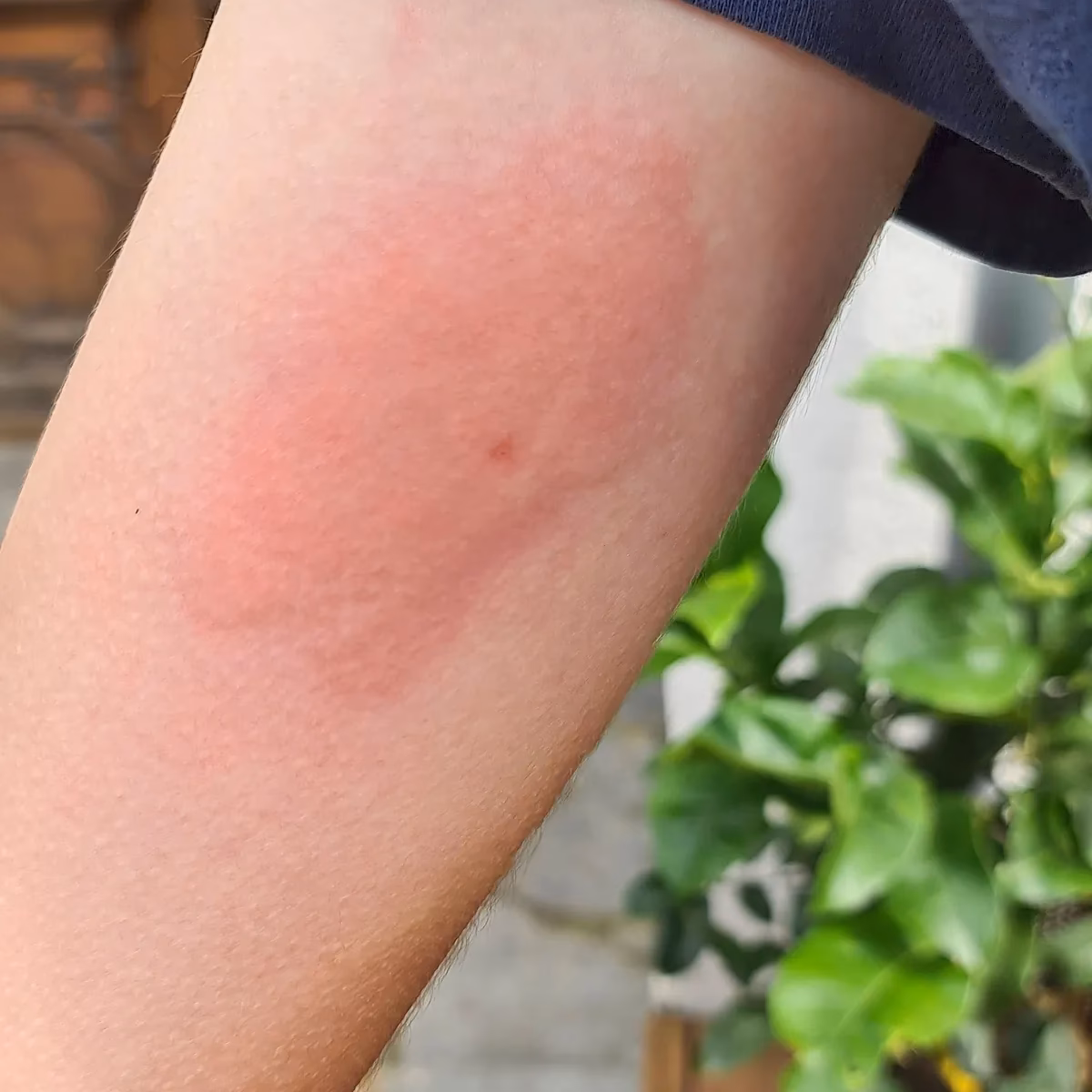 Was passiert bei einer Histaminintoleranz?