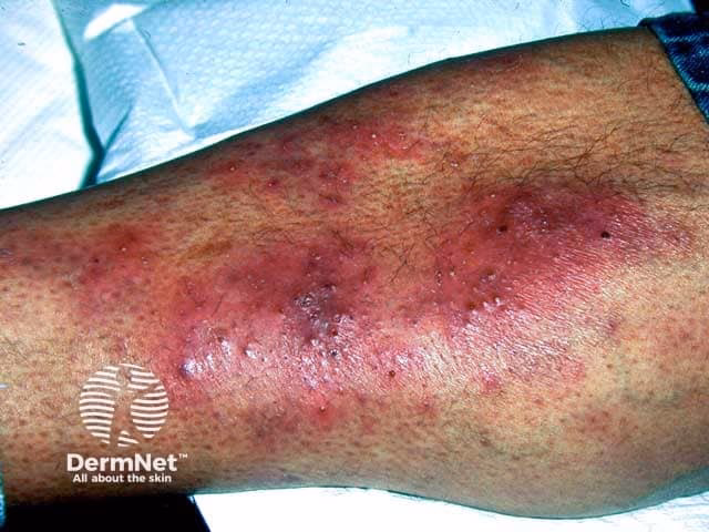 What are the musculoskeletal manifestations of HIV/AIDS?