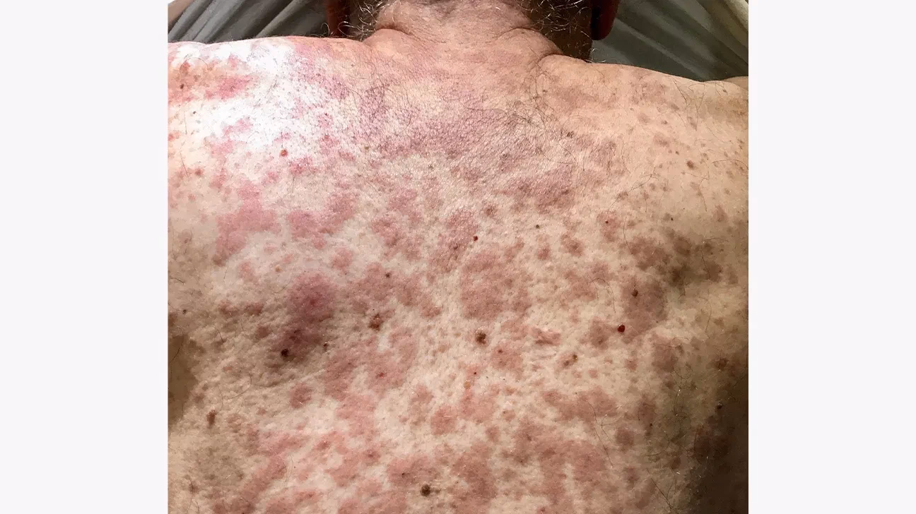 How do you treat HIV rashes?