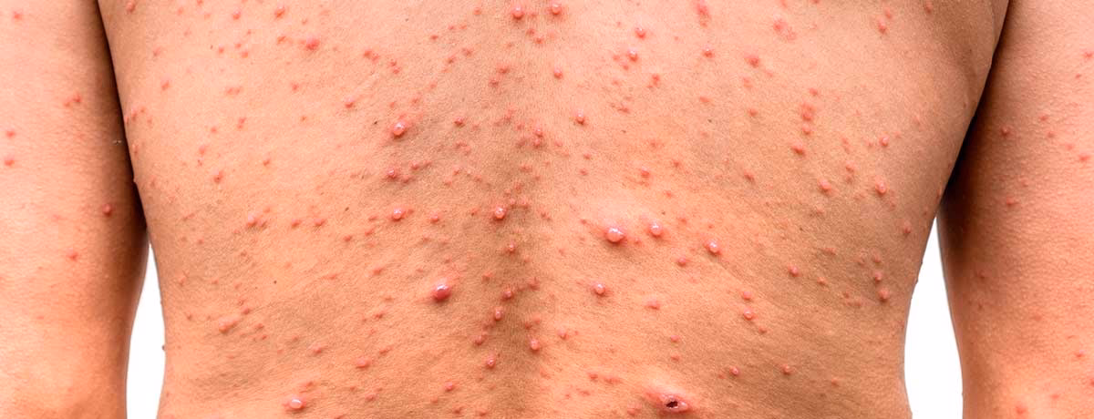 Can anti-HIV drugs cause skin rashes?