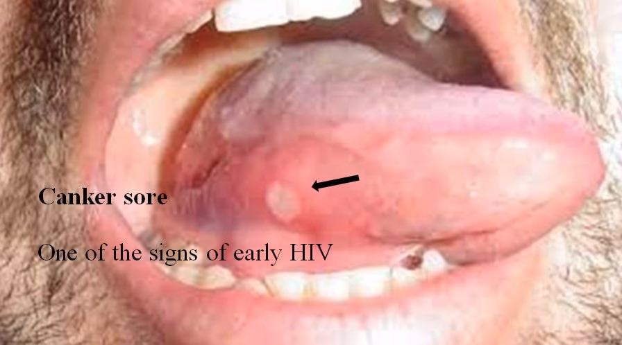 What if you have HIV in your mouth?