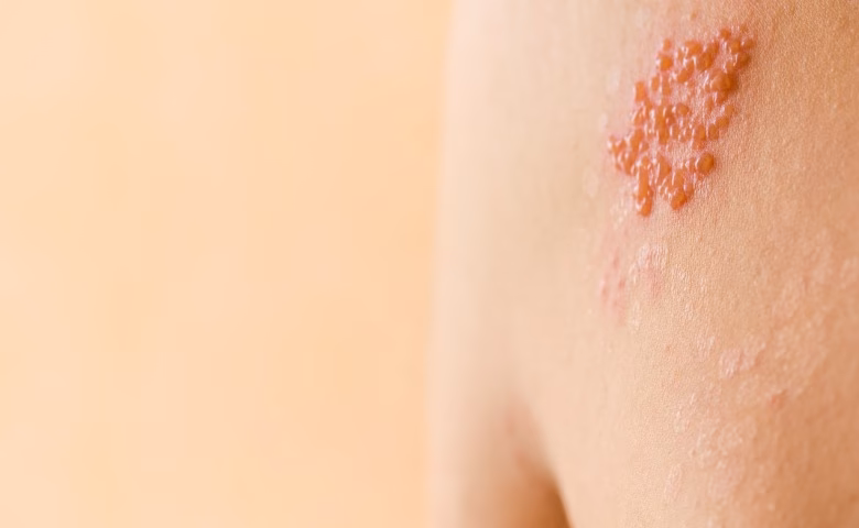 Berapa persen penderita HIV/AIDS yang terinfeksi PCP?