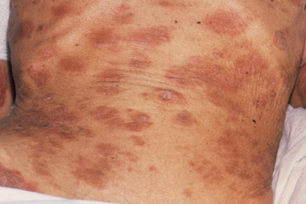 Berapa persen penderita HIV/AIDS yang terinfeksi PCP?