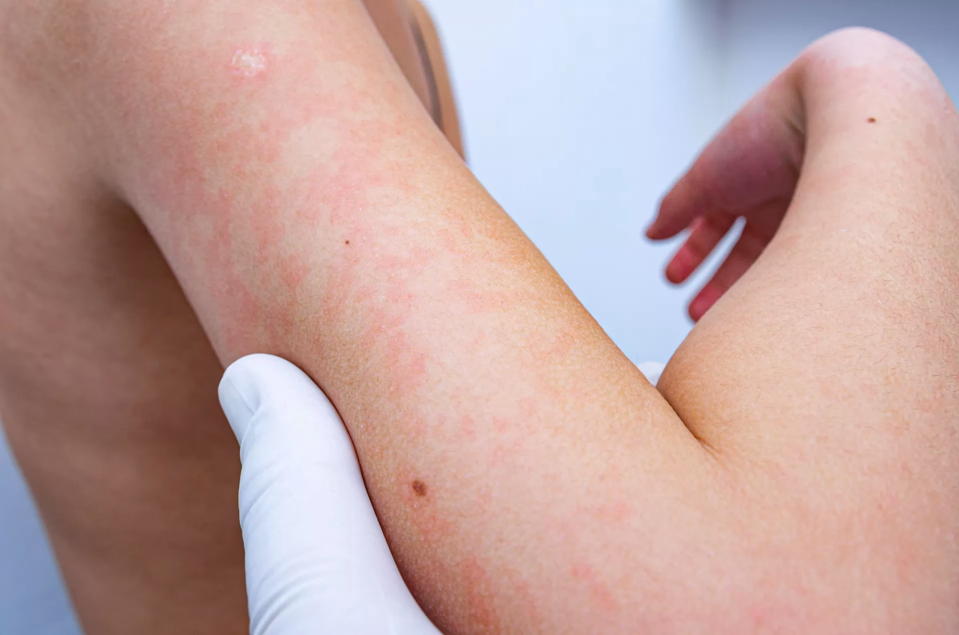 What do hives look like in children?