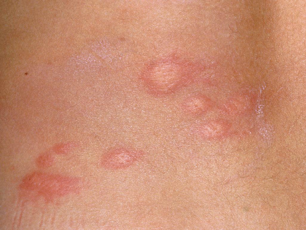 Can a baby get hives if he broke out?