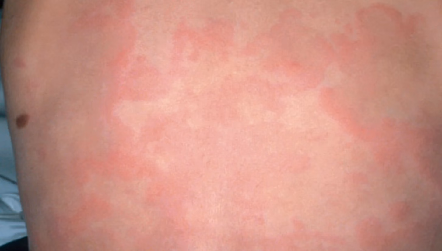How long do hives last in a child?
