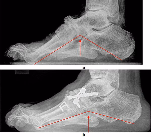 Welche Arten von Hohlfuß-Behandlung gibt es?