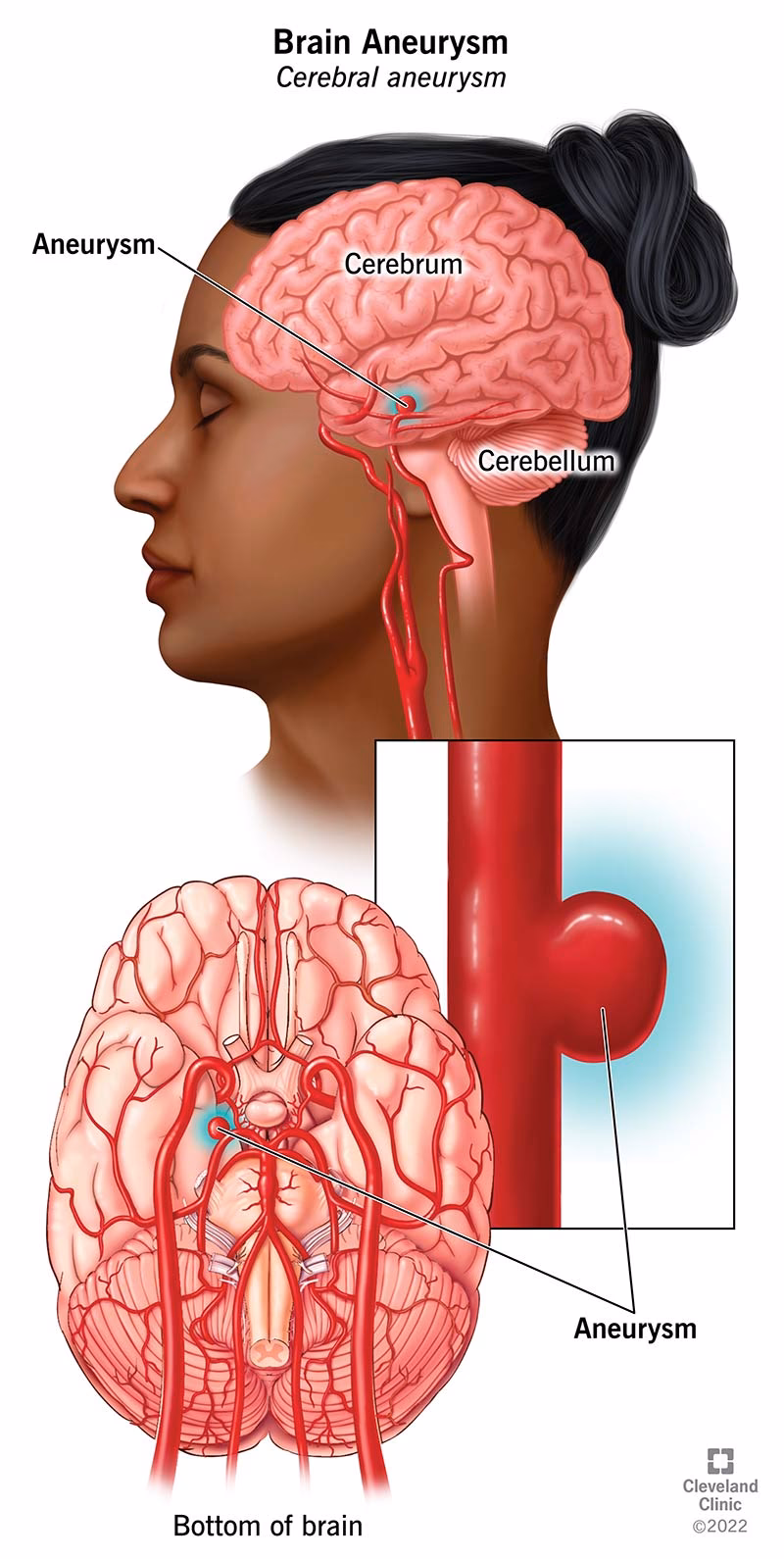 What should I expect after a brain aneurysm surgery?