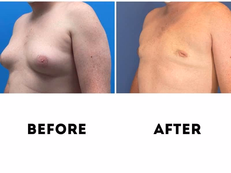 What is the recovery time for gynecomastia surgery?