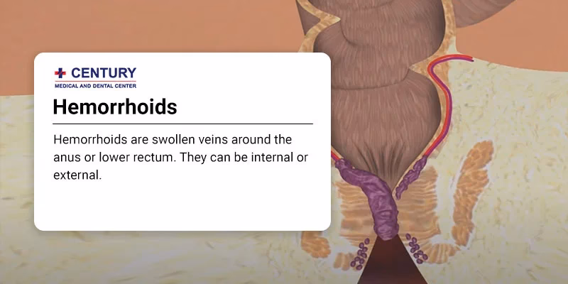 How long do hemorrhoids last?