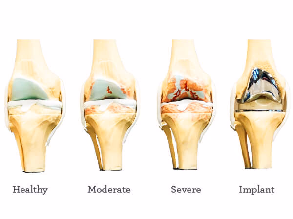 How long does it take to recover from knee replacement surgery?