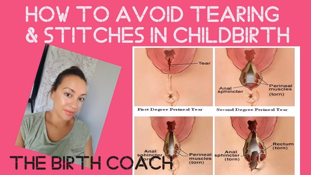 How common is tearing during labor?