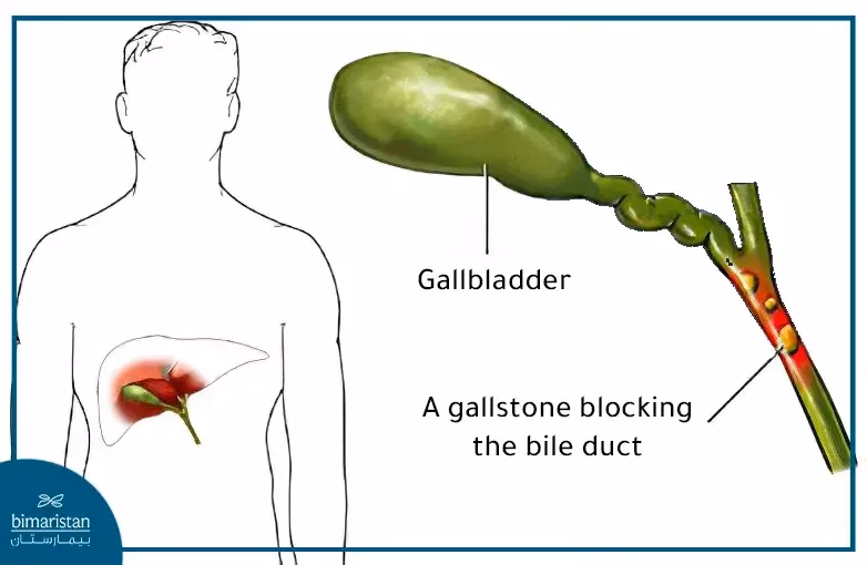 Can a gallbladder stone disappear without surgery?