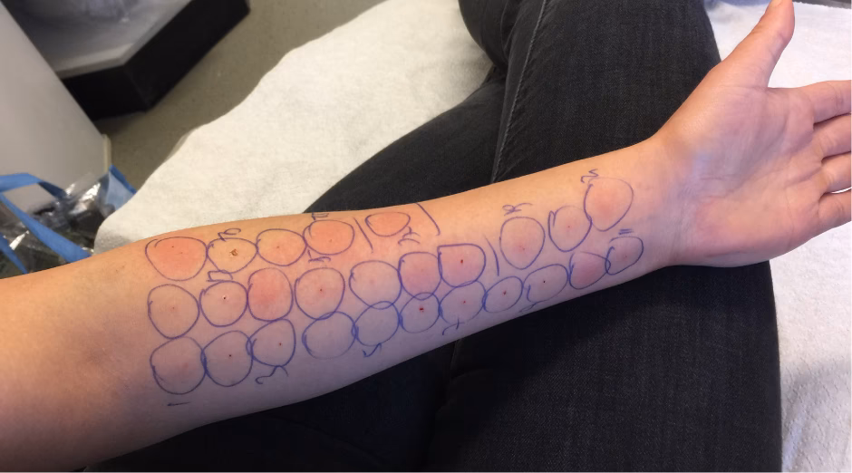 What is a food allergy test?