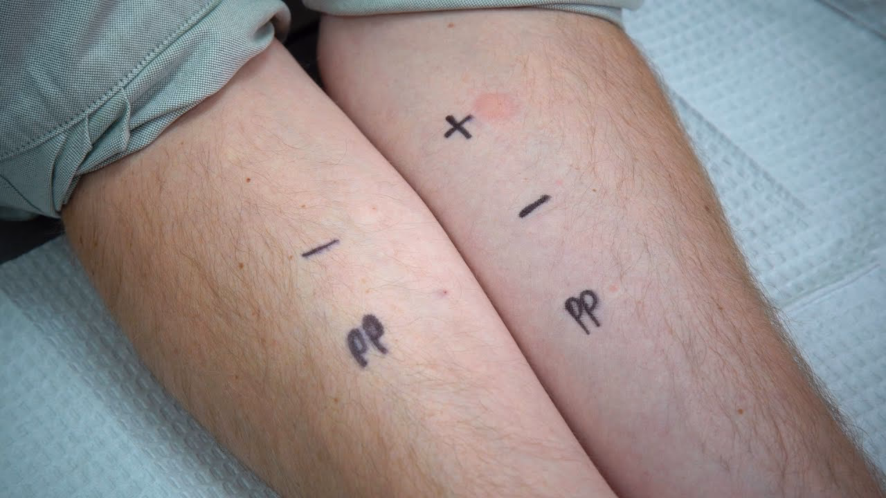 Can a penicillin allergy be diagnosed?