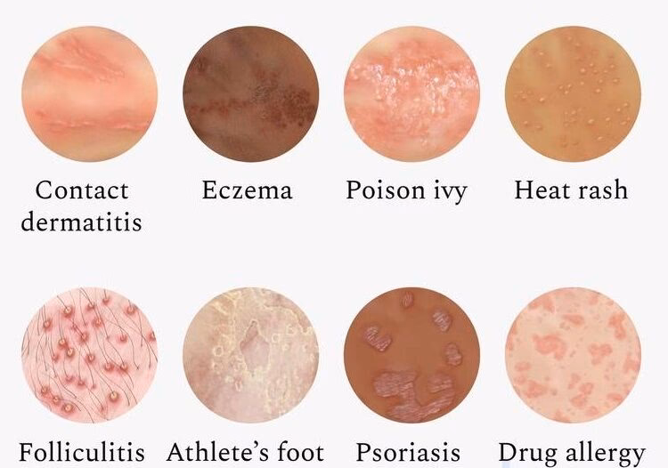 Can oatmeal help a skin allergic reaction?