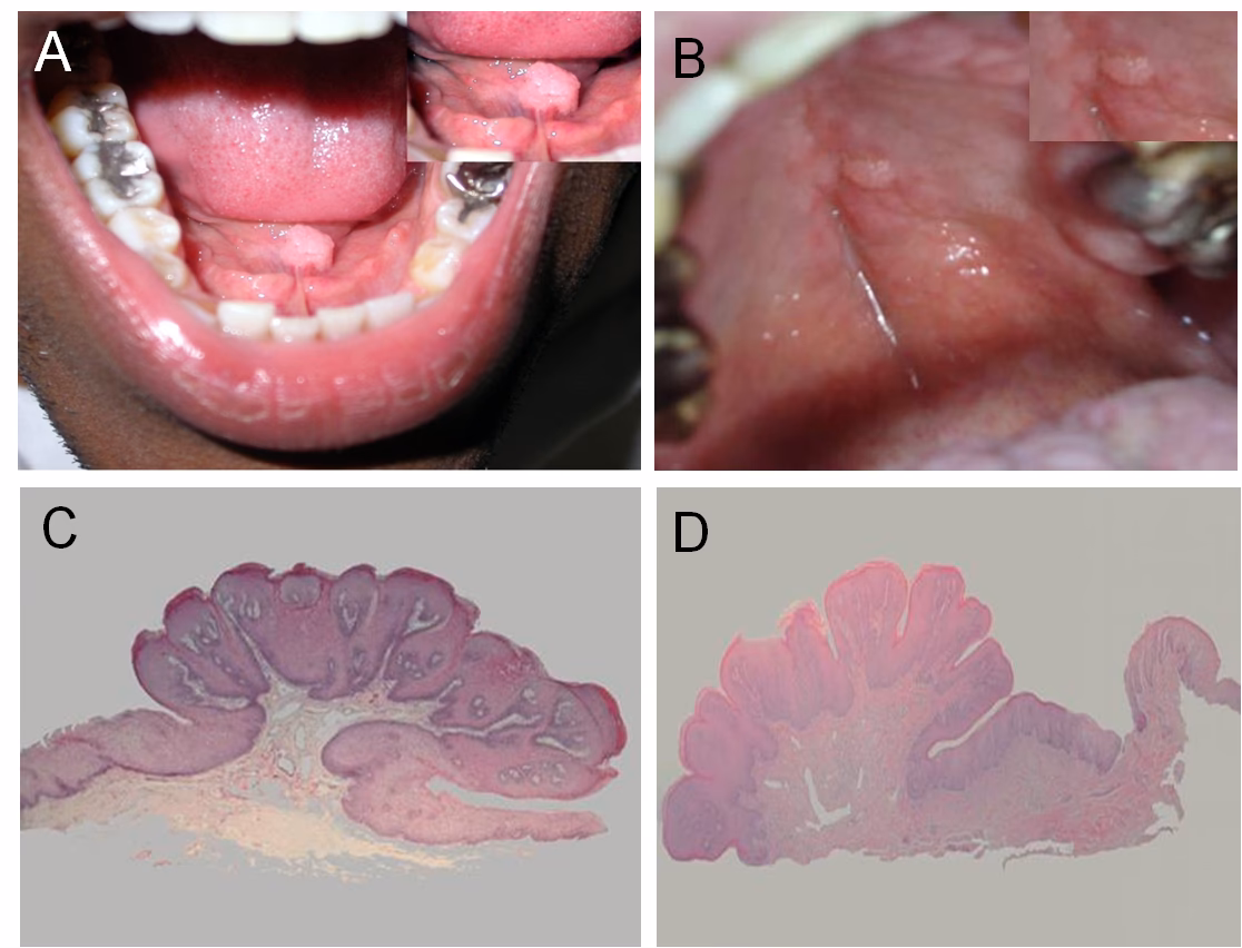 What is oral HPV?