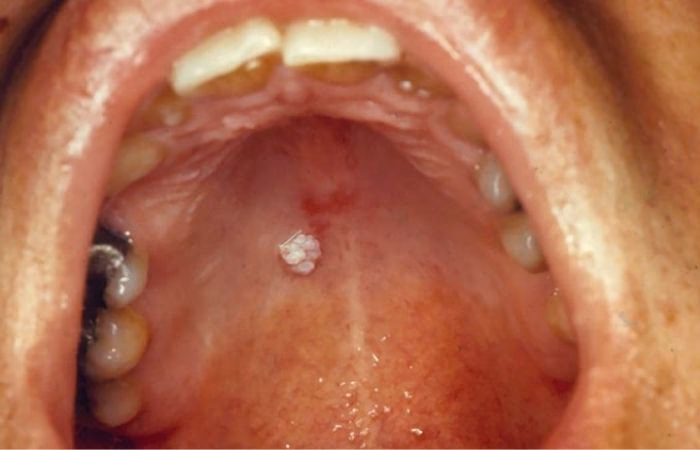 Does oral sex increase the risk of oral HPV infection?