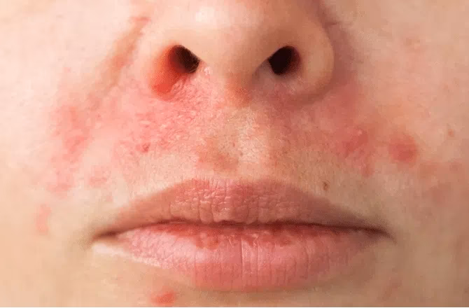 Er der skæl i øjenlågskanten?