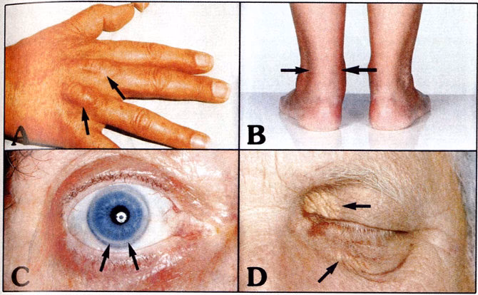 Hvad er dyslipidæmi?