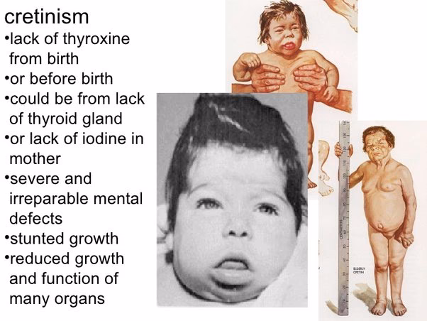 What are the signs and symptoms of hyperthyroidism in infants?