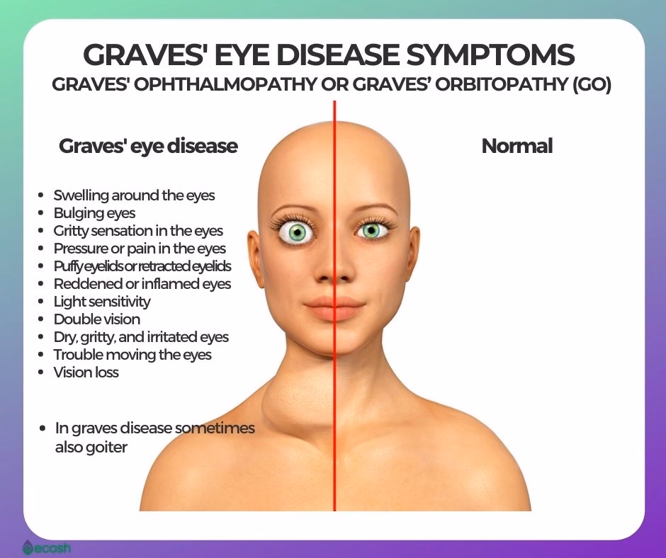 What is Graves' disease?