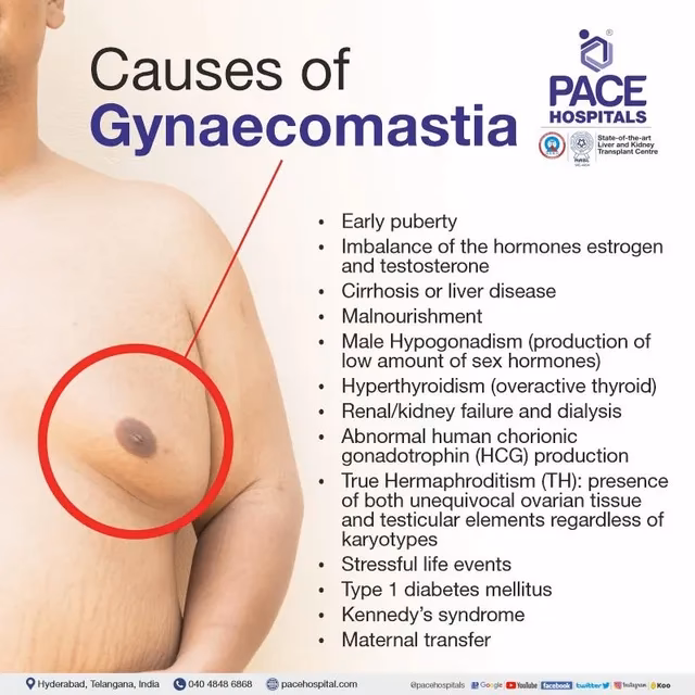 How is gynecomastia treated in patients with hypogonadism?