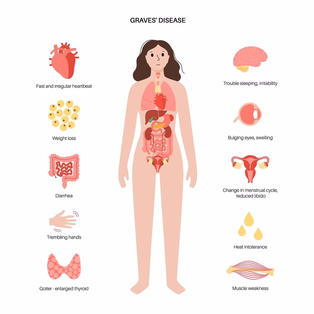 Do thyroid conditions cause low libido?