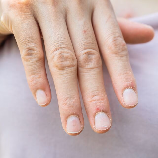 Can thyroid disease cause brittle nails?