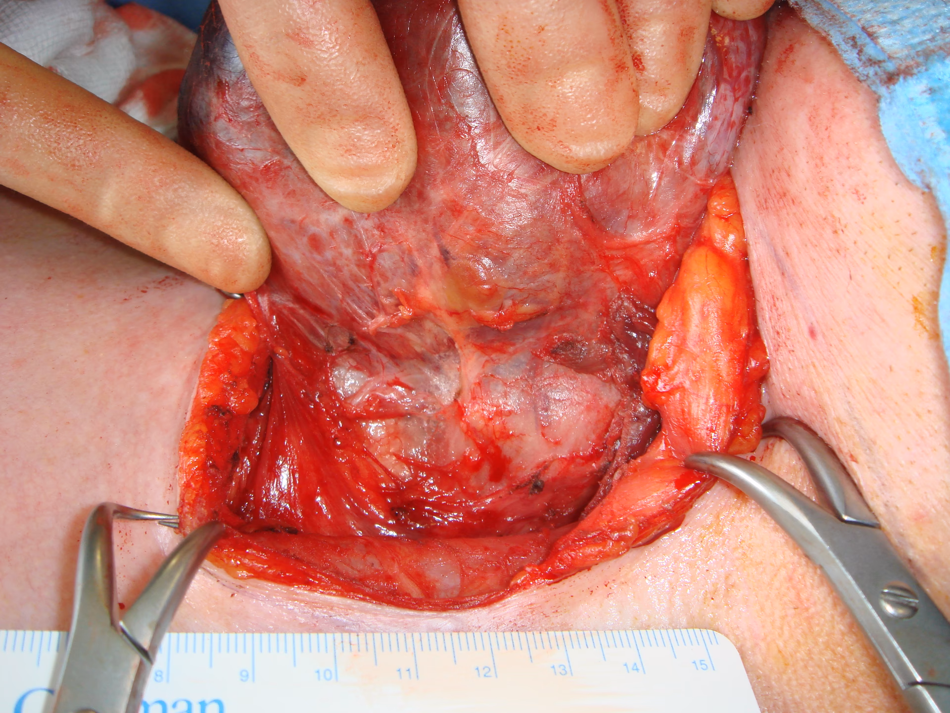 Can a thyroidectomy be performed If I have hyperthyroidism?