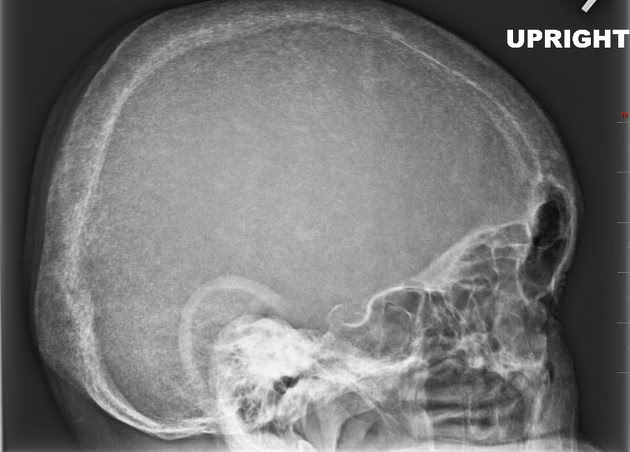 What are extrathyroidal manifestations of Graves disease?