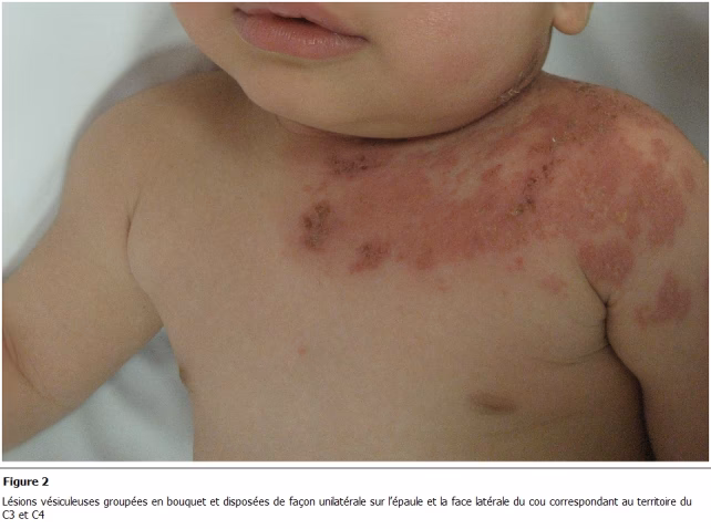 Can newborns get chickenpox?