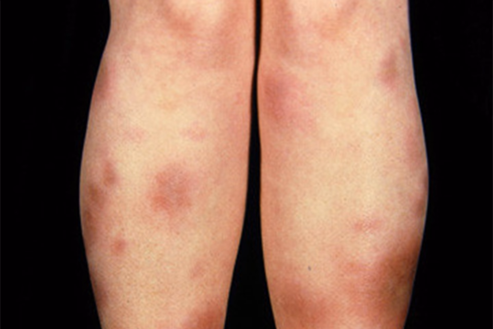 Is UC a symptom of inflammatory bowel disease (IBD)?