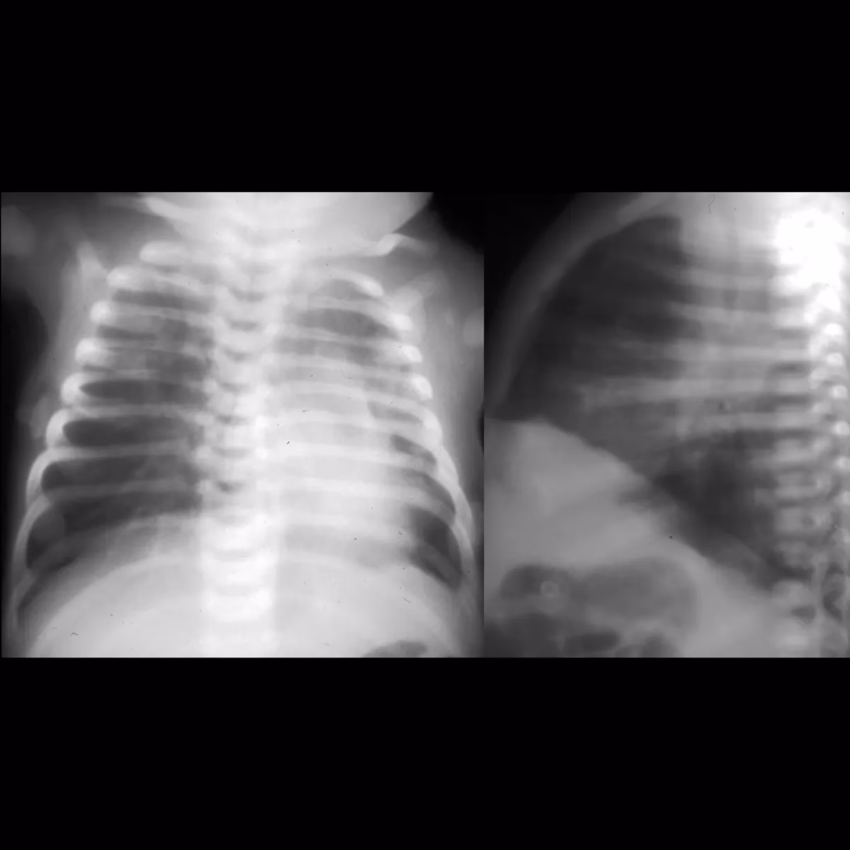 Can antibiotics help with whooping cough?