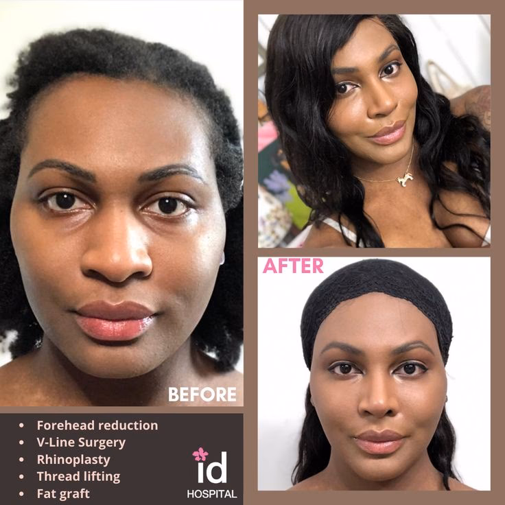 What is facial feminization surgery (FFS)?