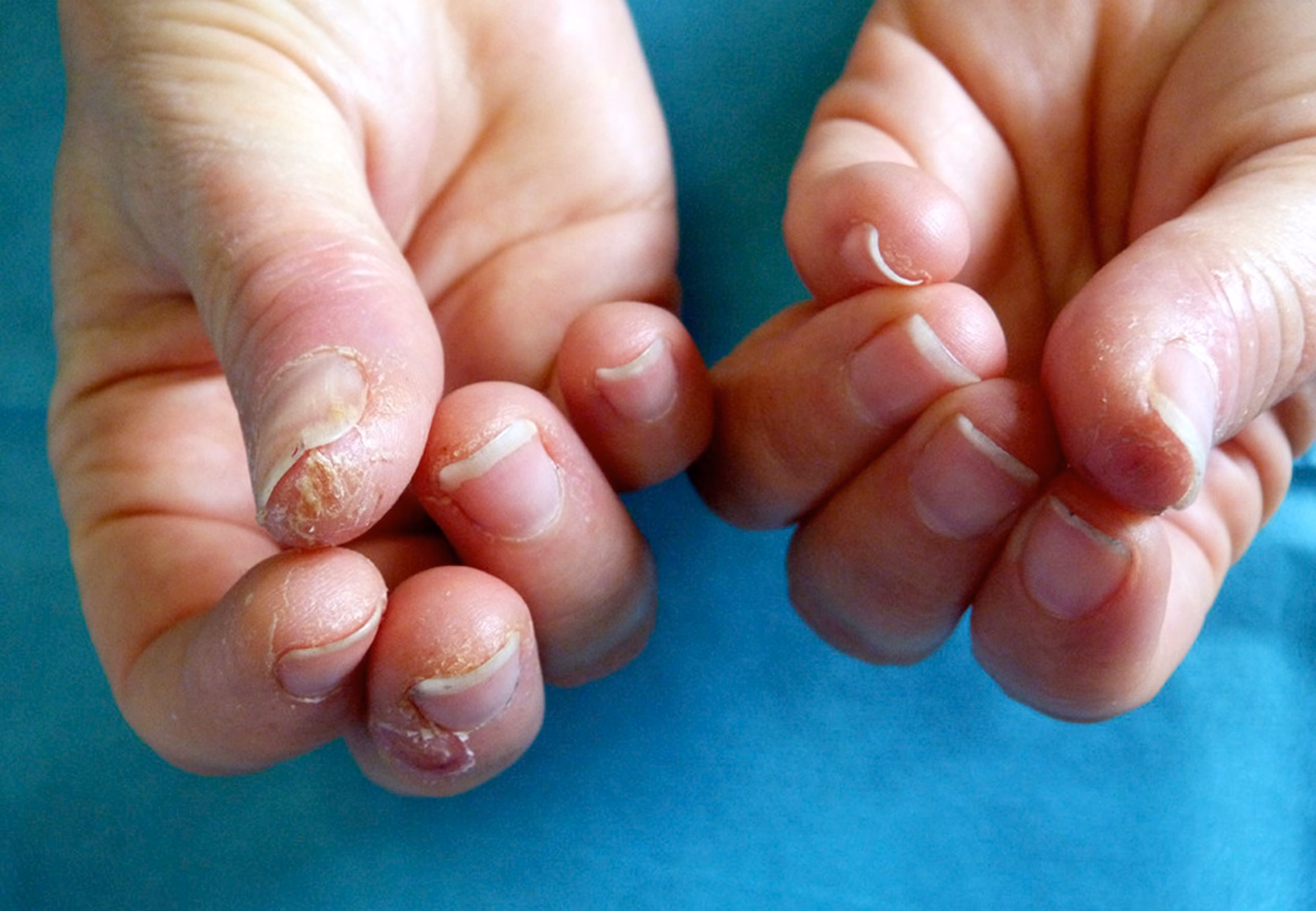 Can contact dermatitis be caused by natural indigo hair dye?