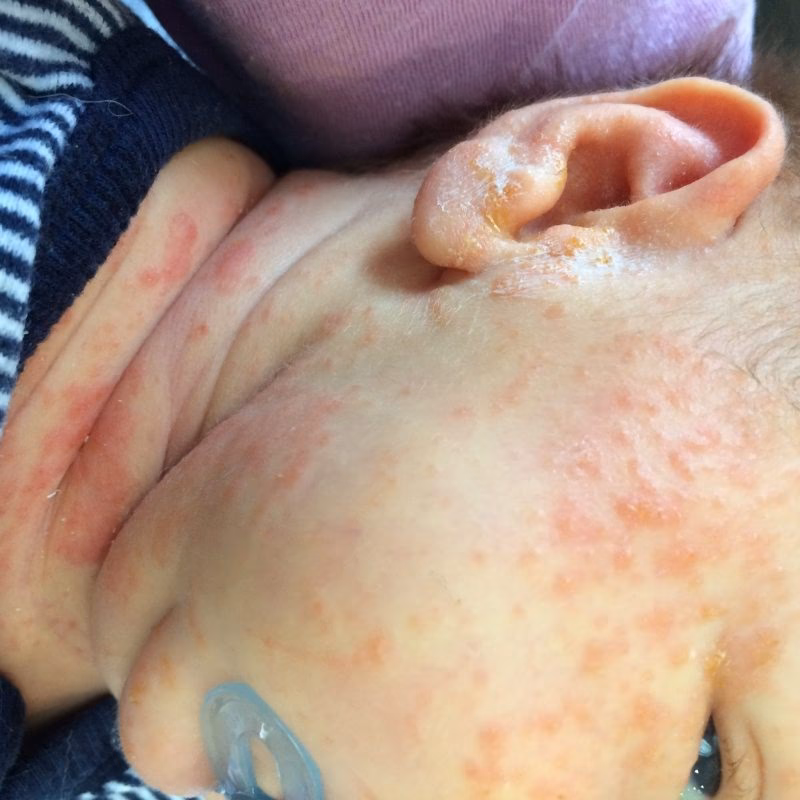 What should I do if my baby is allergic to breast milk?