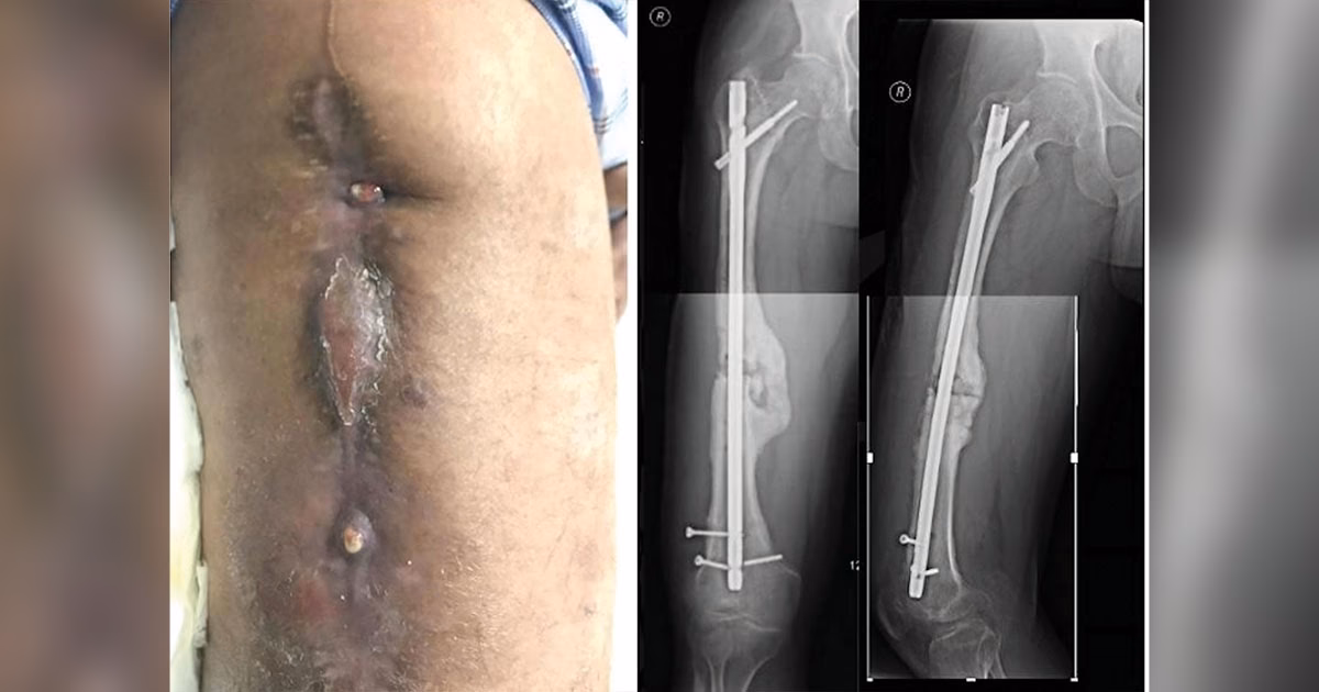 Is infection after fracture fixation a complication in orthopaedic surgery?