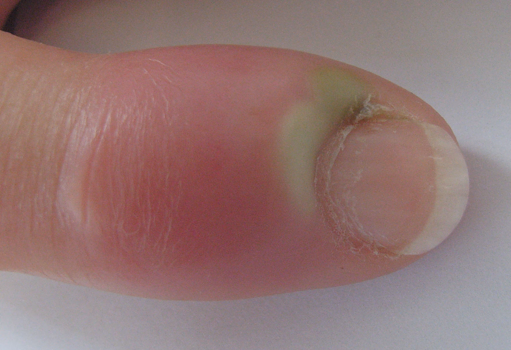 Hvad er hånd- og fingerinfektioner?