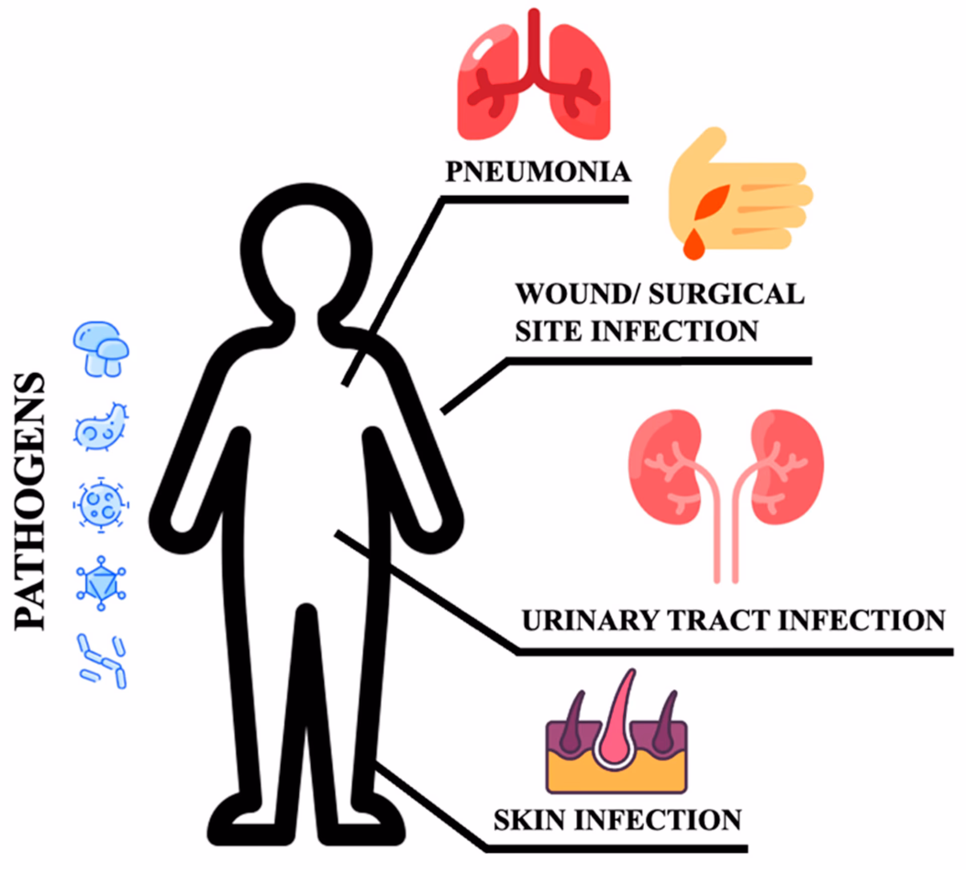 Does diabetes mellitus increase risk of common infections?