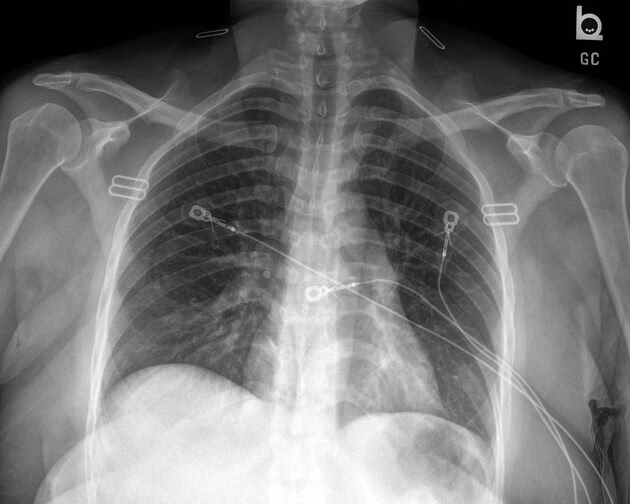 What happens if a respiratory swab is positive for influenza A virus RNA?