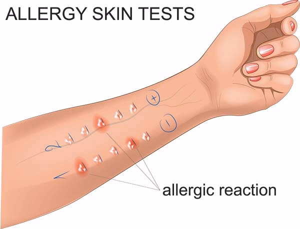 What is an intradermal allergy test?