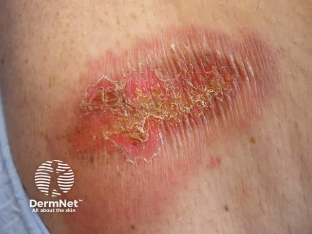 How do I know if I have an iodine allergy?